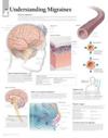 Understanding Migraines Laminated Poster