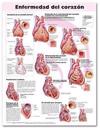 Heart Disease Anatomical Chart in Spanish (Enfermedad del corazón)