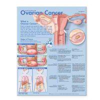 Understanding Ovarian Cancer Anatomical Chart + Anatomy of the Brain Chart