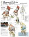 Rheumatoid Arthritis Laminated Poster
